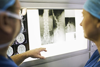 Brain Aneurysm Imaging Brain Aneurysm Imaging